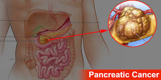 pancreatic_cancer